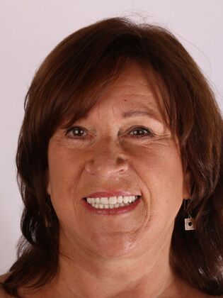 Dental Implants Sherry - After