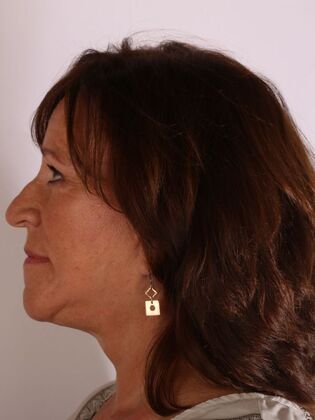 Dental Implants: Sherry - After