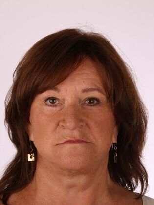 Dental Implants: Sherry - Before