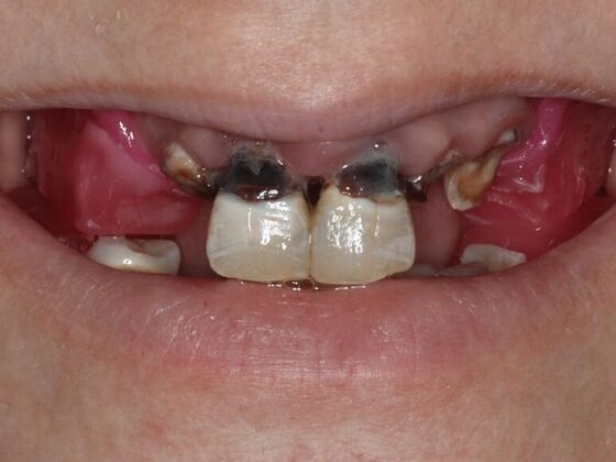 Dental Implants: Heather - Before