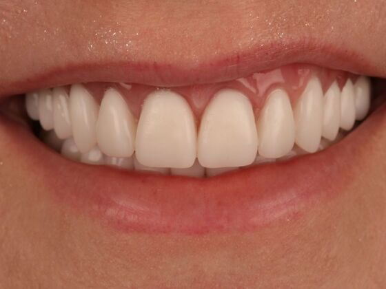 Dental Implants: Heather - After