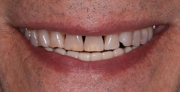 Dental Implants: John - Before