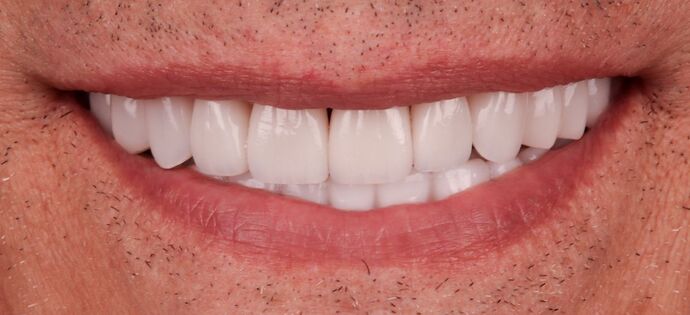 Dental Implants: John - After