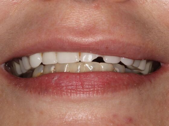 Dental Implants: Rachel - Before