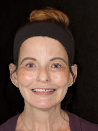 Dental Implants Rachel - Before