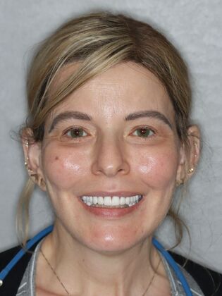 Dental Implants Rachel - After