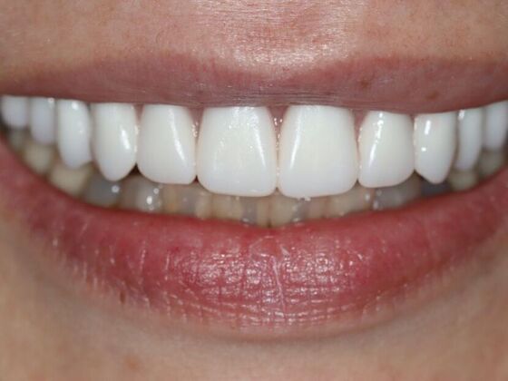 Dental Implants: Rachel - After