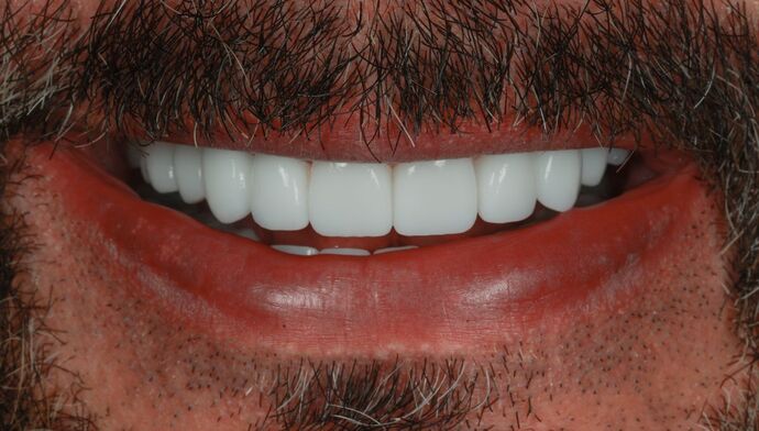 Full Mouth Reconstruction: Andy - After