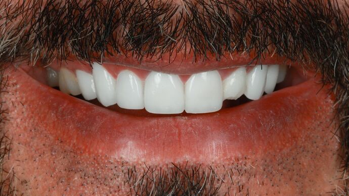 Full Mouth Reconstruction: Andy - Before