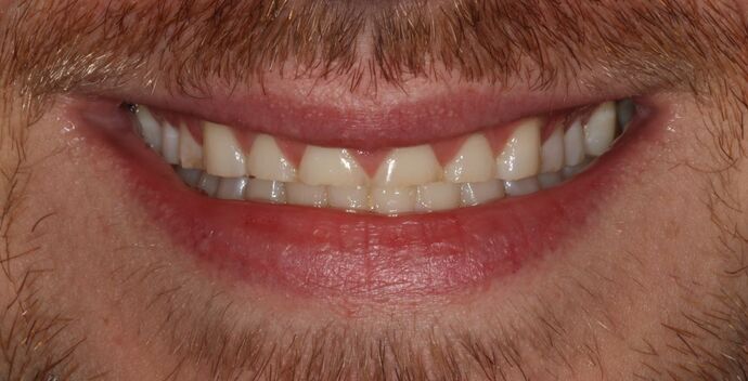 Full Mouth Reconstruction: Anthony - Before