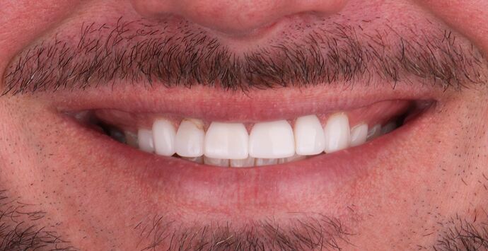 Full Mouth Reconstruction: Chans - Before