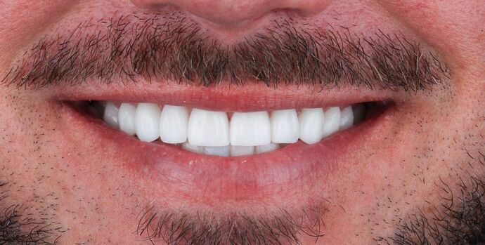 Full Mouth Reconstruction: Chans - After