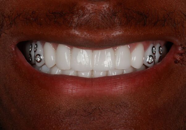 Full Mouth Reconstruction: Chavarius - After