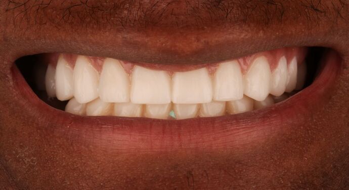Full Mouth Reconstruction: Chavarius - Before