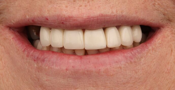 Full Mouth Reconstruction: Tomeka - Before