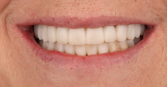 Full Mouth Reconstruction: Tomeka - After