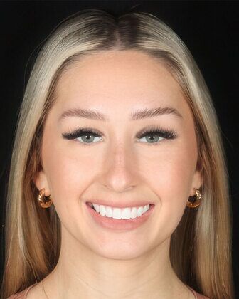 Veneers Cases