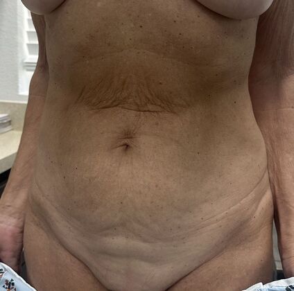 Massive Weight Loss : Case 228 - Before