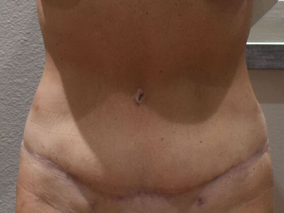 Massive Weight Loss : Case 228 - After
