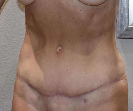 Massive Weight Loss : Case 228 - After