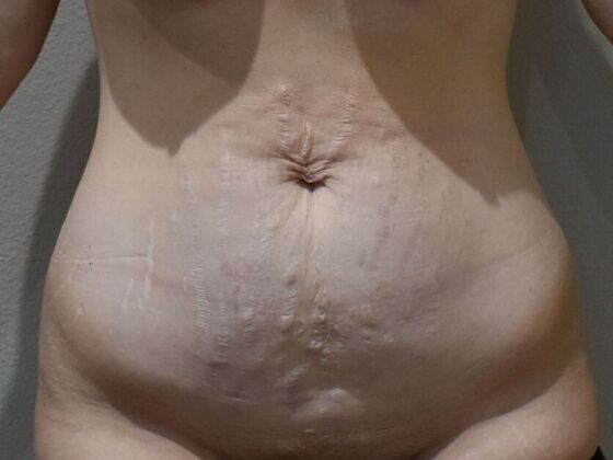 Tummy Tuck (Abdominoplasty): Case 610 - Before
