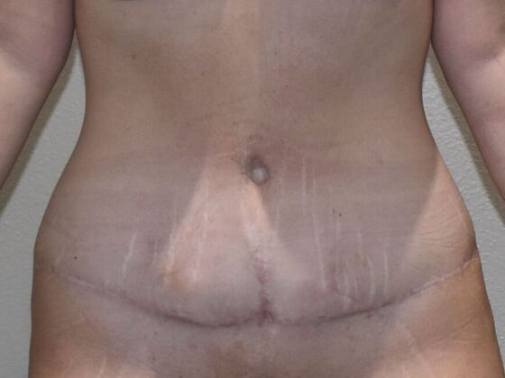 Tummy Tuck (Abdominoplasty): Case 610 - After
