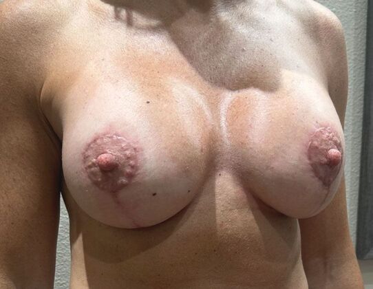 Breast Augmentation w/ Lift: Case 13 - After