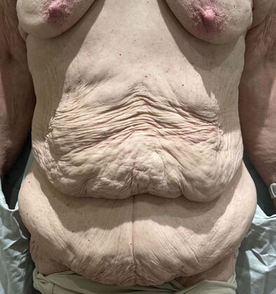 Massive Weight Loss : Case 3 - Before