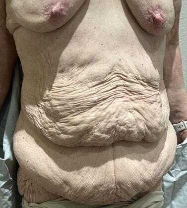 Massive Weight Loss : Case 3 - Before