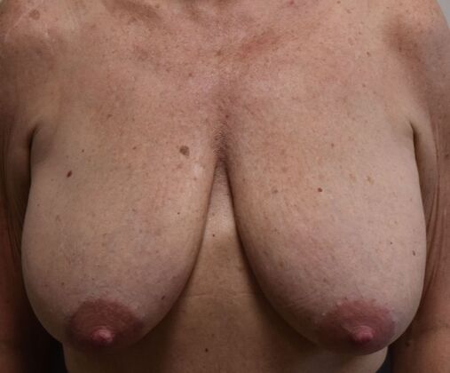 Breast Lift (Mastopexy) Case 282 - Before