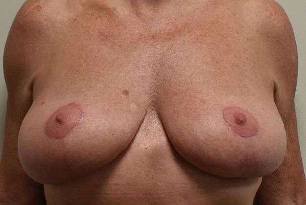 Breast Lift (Mastopexy) Case 282 - After