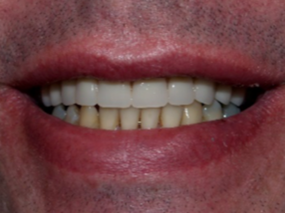 Dental Implants: Case 1 - After
