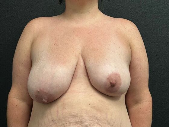 Breast Lift Breast Lift 11 - Before