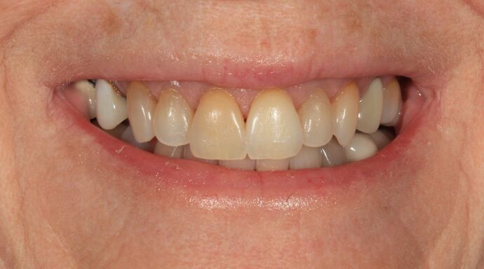 Full Mouth Reconstruction: Case 54 - Before