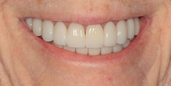 Full Mouth Reconstruction: Case 54 - After