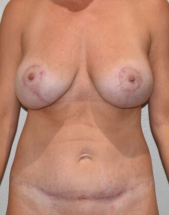 Mommy Makeover Case 362 - After