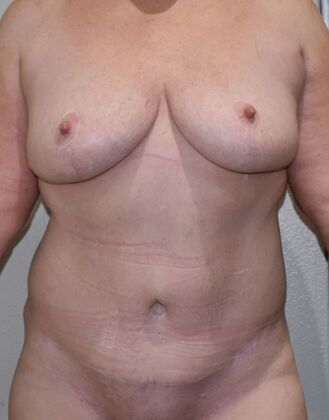 Mommy Makeover Case 7 - After