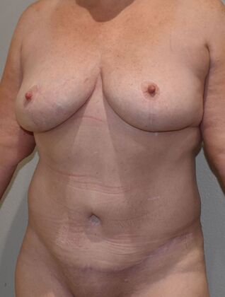 Mommy Makeover: Case 7 - After