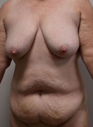 Mommy Makeover: Case 7 - Before