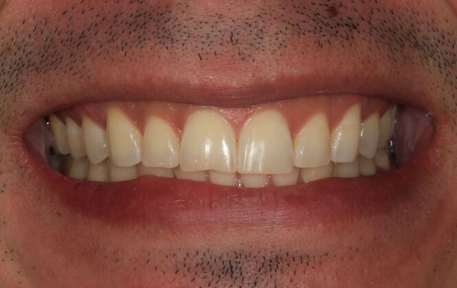 Porcelain Veneers: Case 3 - Before