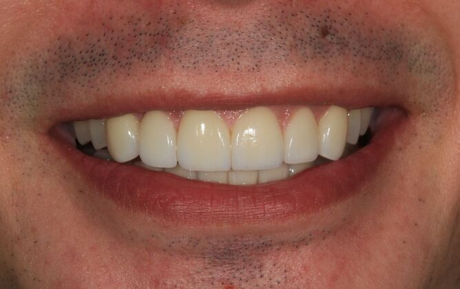 Porcelain Veneers: Case 3 - After