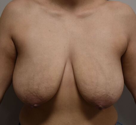 Breast Lift (Mastopexy) Case 283 - Before