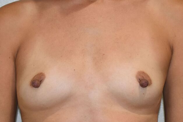 Breast Augmentation Case 836 - Before