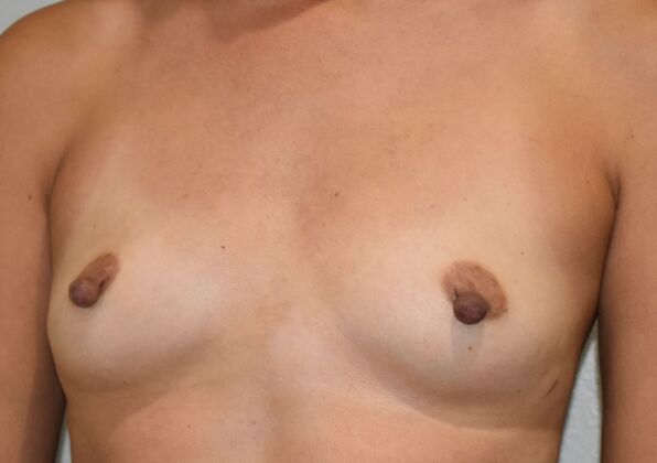 Breast Augmentation: Case 836 - Before