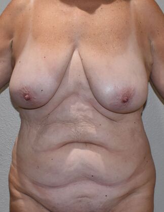Massive Weight Loss : Case 8 - Before