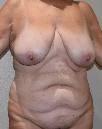 Massive Weight Loss : Case 8 - Before