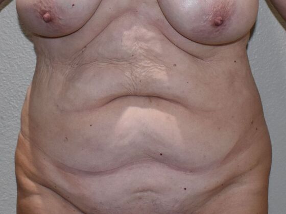 Tummy Tuck (Abdominoplasty) Case 611 - Before