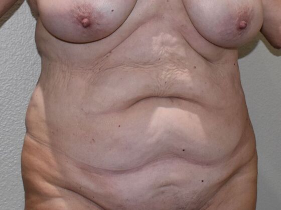 Tummy Tuck (Abdominoplasty): Case 611 - Before
