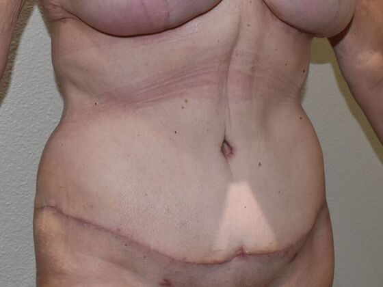 Tummy Tuck (Abdominoplasty): Case 611 - After