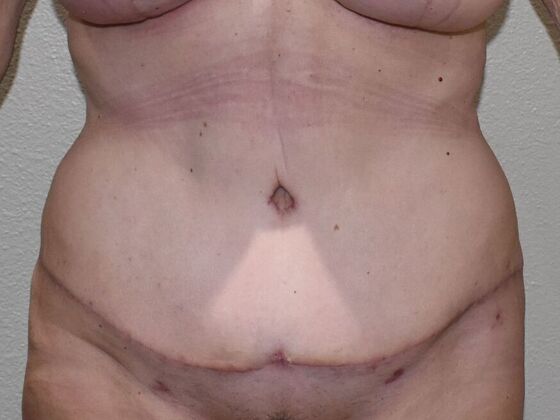 Tummy Tuck (Abdominoplasty) Case 611 - After